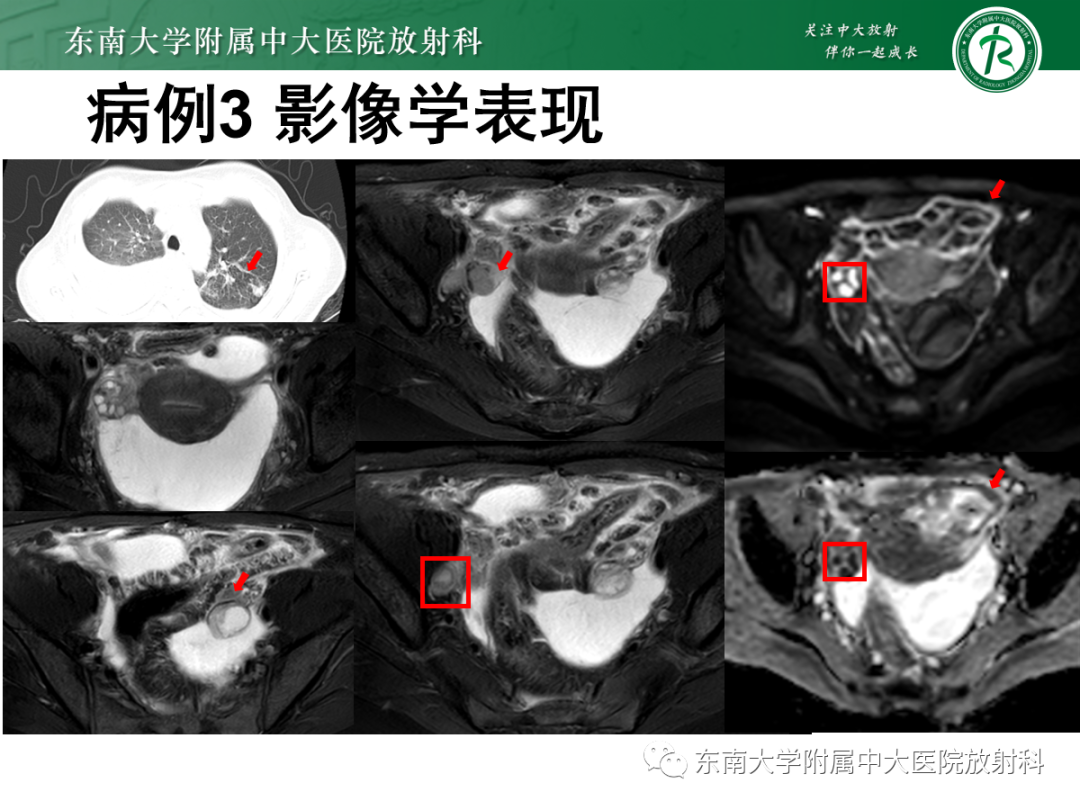 影像PPT - 【PPT】腹膜弥漫性病变-22 影像PPT - 【PPT】腹膜弥漫性病变-22