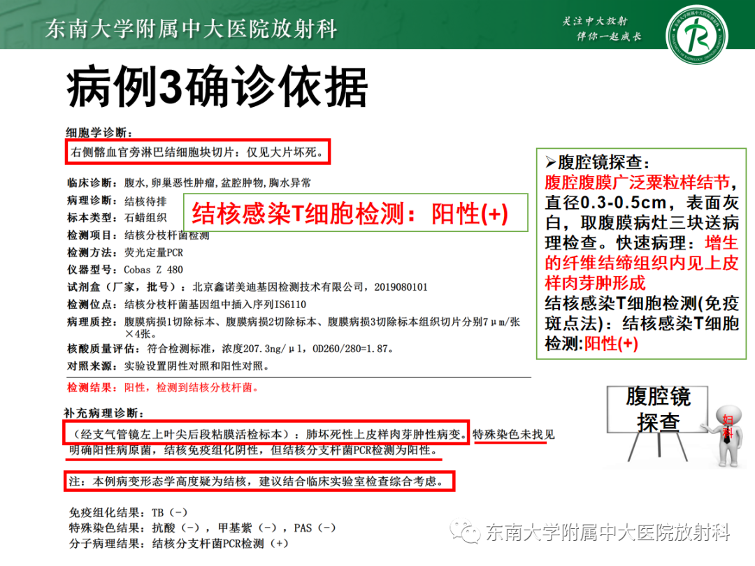 影像PPT - 【PPT】腹膜弥漫性病变-25 影像PPT - 【PPT】腹膜弥漫性病变-25