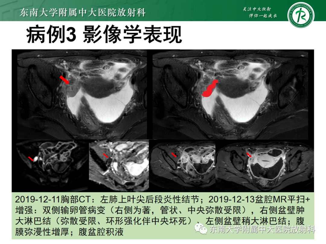 影像PPT - 【PPT】腹膜弥漫性病变-23 影像PPT - 【PPT】腹膜弥漫性病变-23