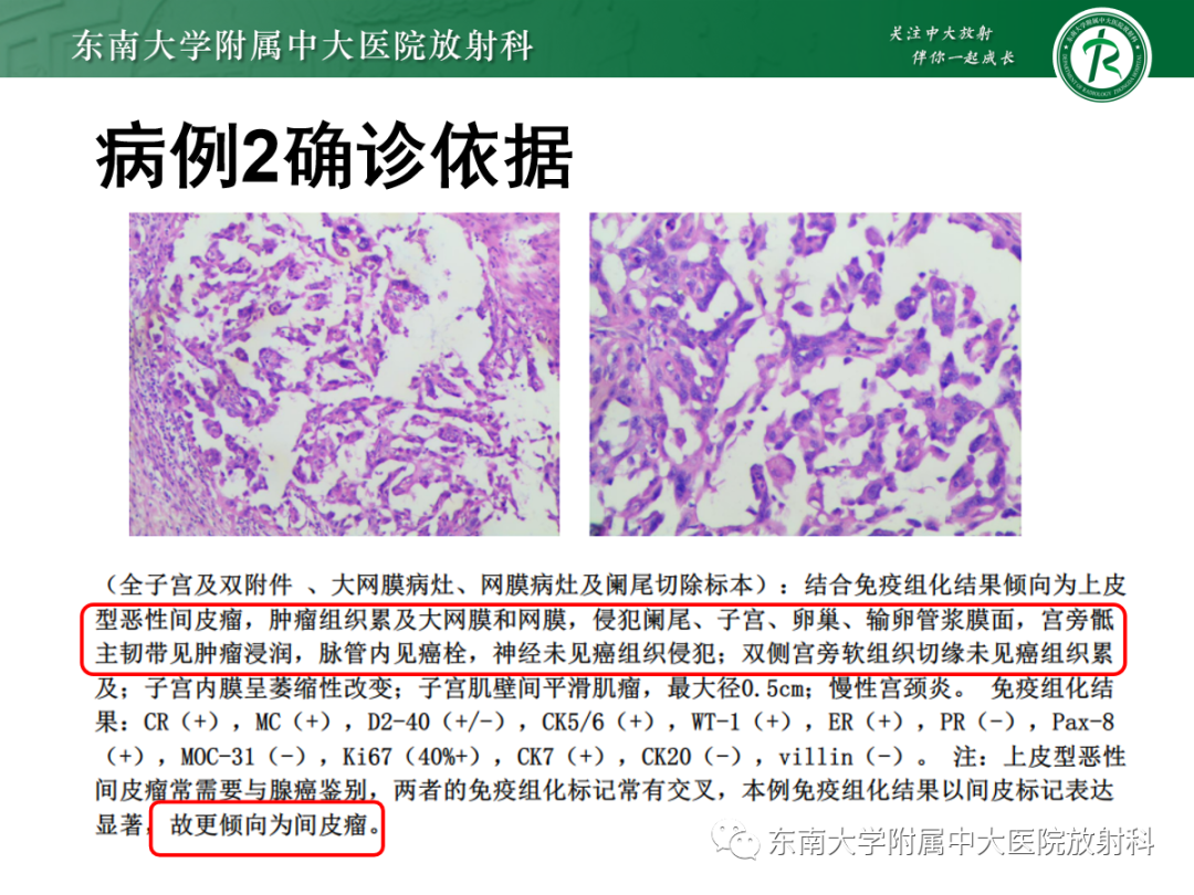 影像PPT - 【PPT】腹膜弥漫性病变-21 影像PPT - 【PPT】腹膜弥漫性病变-21