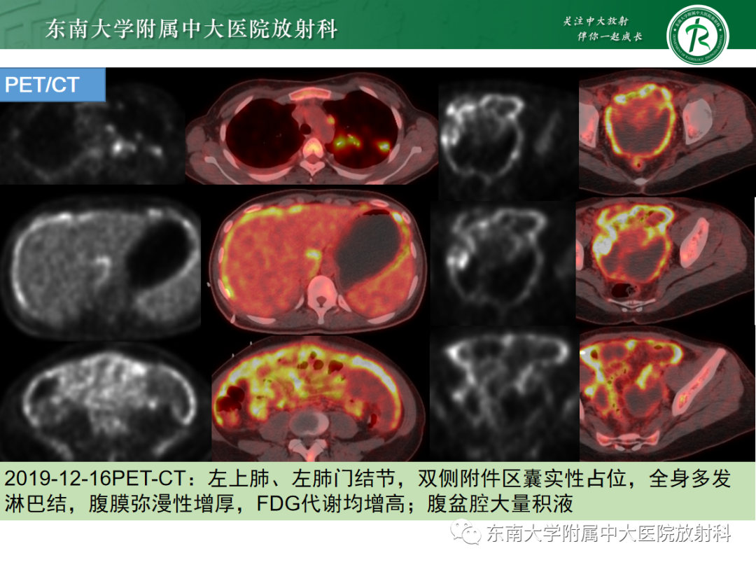 影像PPT - 【PPT】腹膜弥漫性病变-24 影像PPT - 【PPT】腹膜弥漫性病变-24