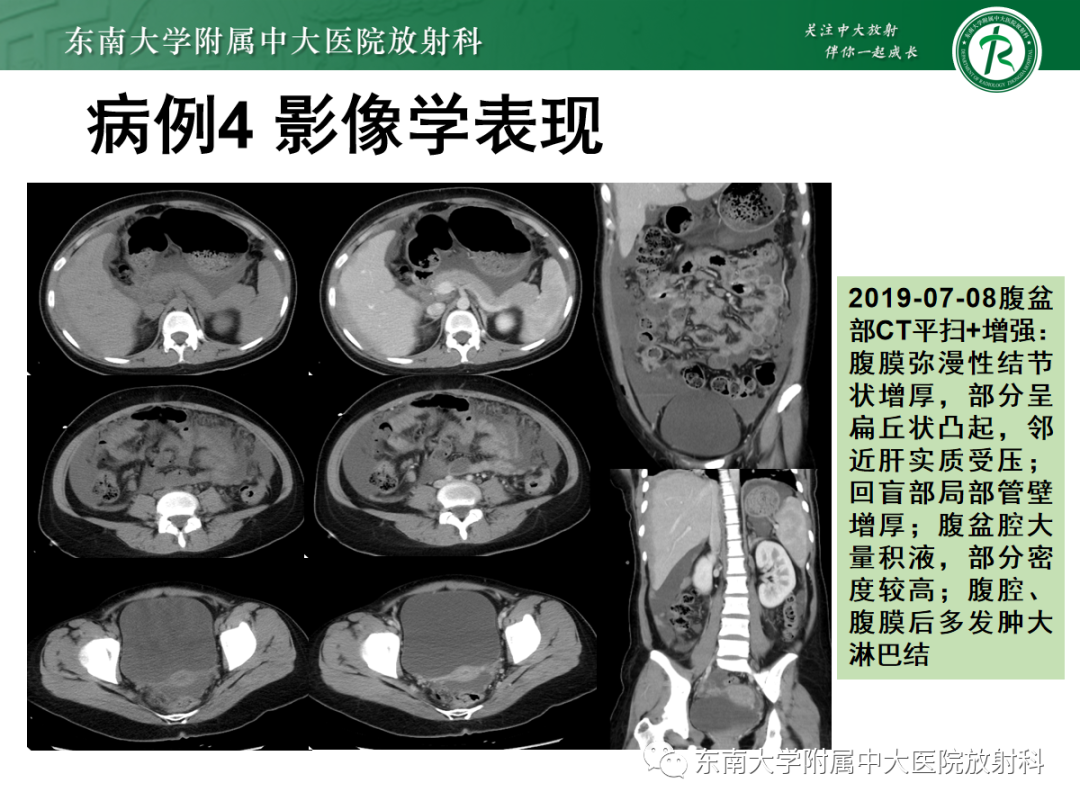 影像PPT - 【PPT】腹膜弥漫性病变-26 影像PPT - 【PPT】腹膜弥漫性病变-26