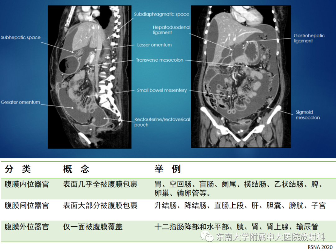 影像PPT - 【PPT】腹膜弥漫性病变-38 影像PPT - 【PPT】腹膜弥漫性病变-38