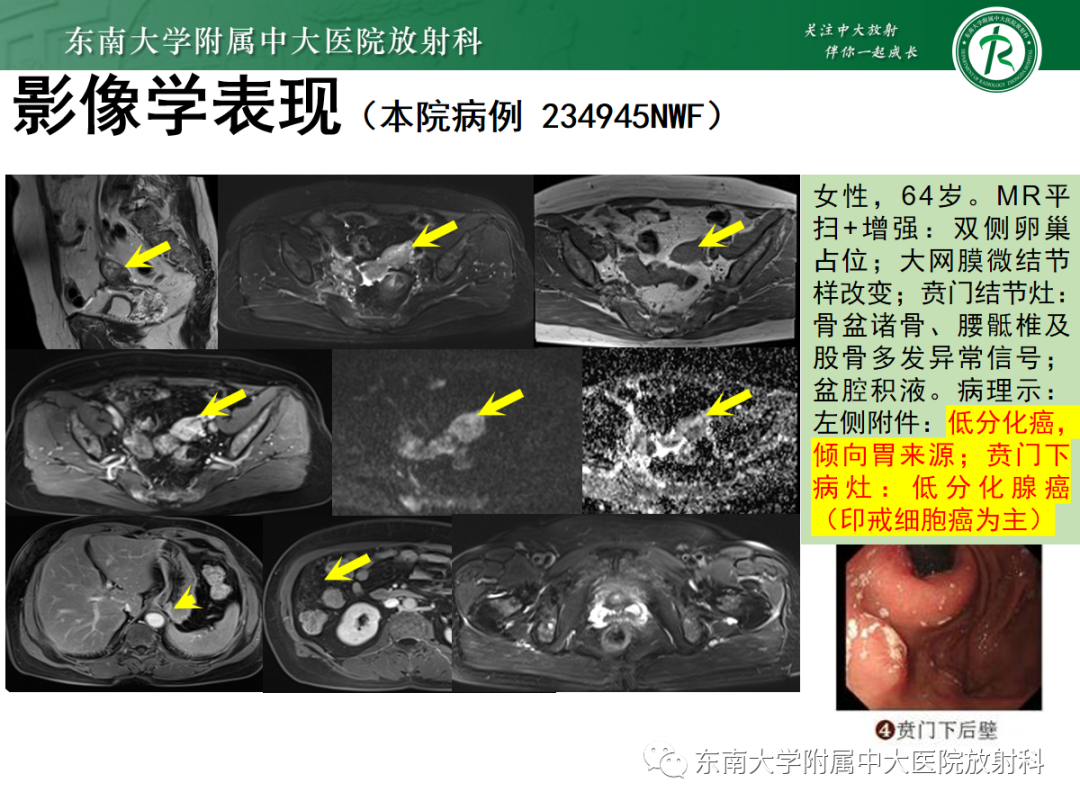 影像PPT - 【PPT】腹膜弥漫性病变-41 影像PPT - 【PPT】腹膜弥漫性病变-41
