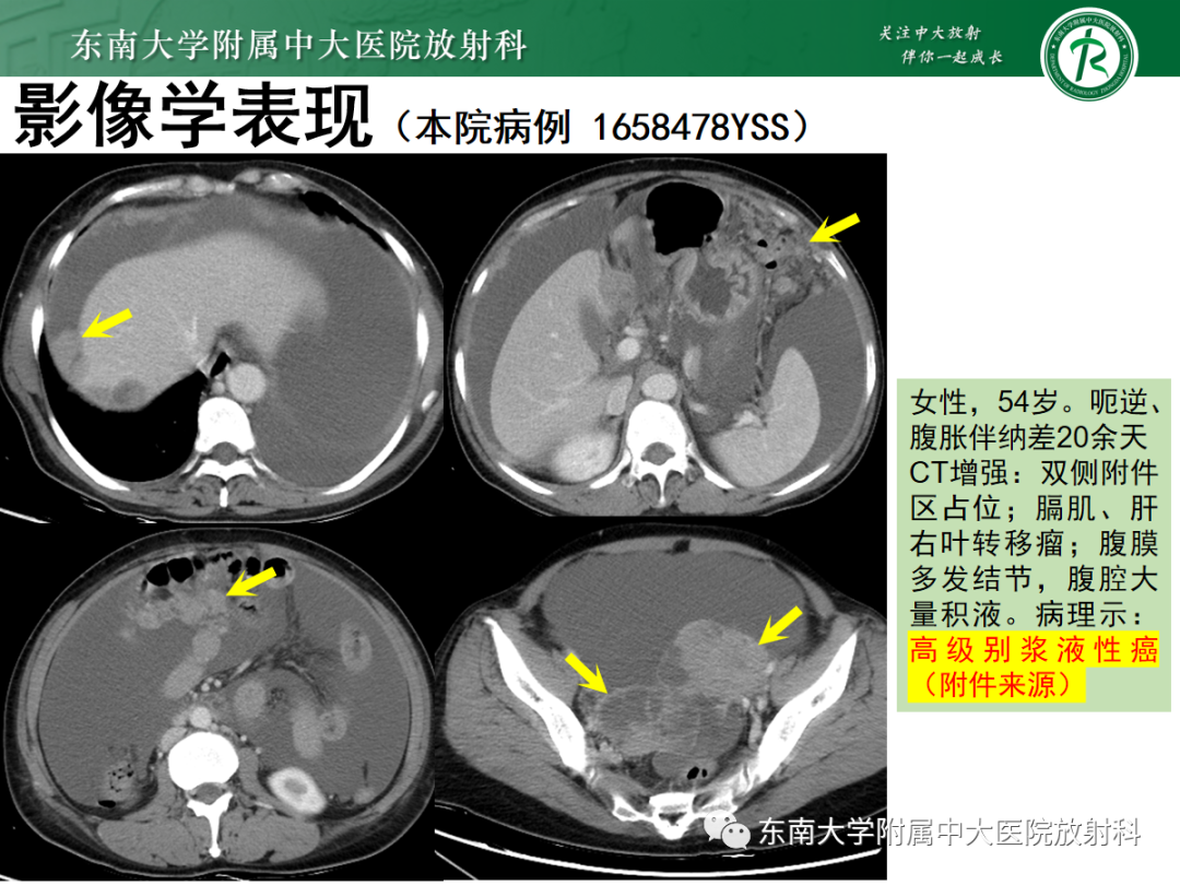 影像PPT - 【PPT】腹膜弥漫性病变-42 影像PPT - 【PPT】腹膜弥漫性病变-42