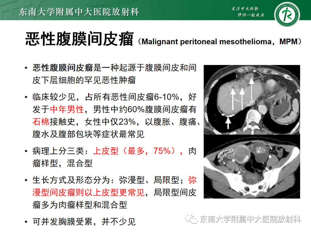影像PPT - 【PPT】腹膜弥漫性病变-43 影像PPT - 【PPT】腹膜弥漫性病变-43