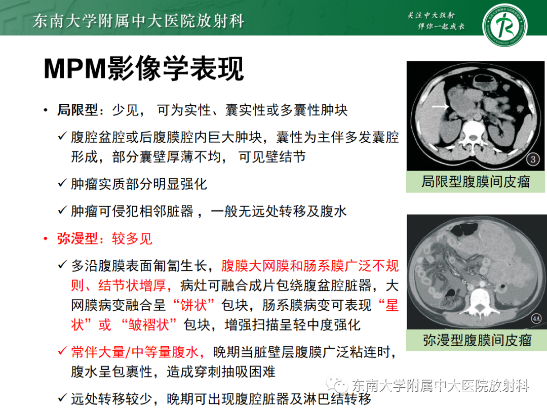 影像PPT - 【PPT】腹膜弥漫性病变-44 影像PPT - 【PPT】腹膜弥漫性病变-44