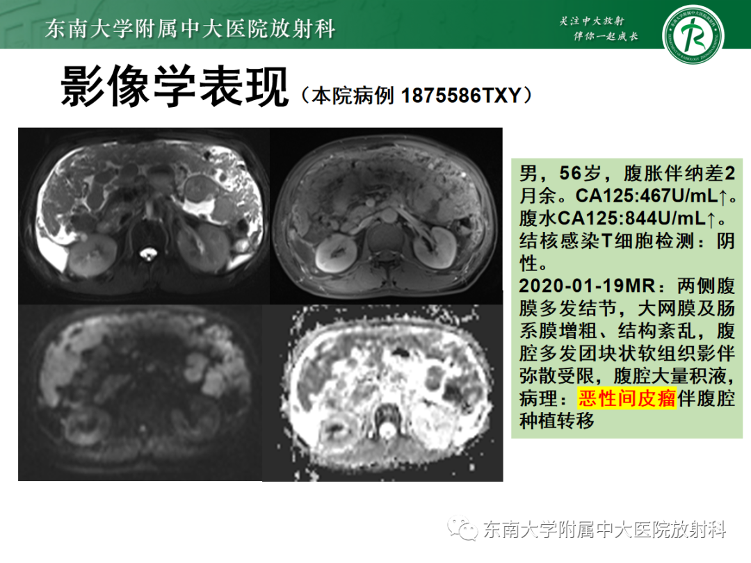 影像PPT - 【PPT】腹膜弥漫性病变-47 影像PPT - 【PPT】腹膜弥漫性病变-47