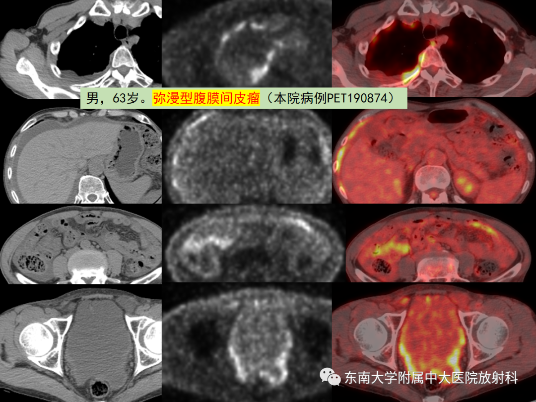 影像PPT - 【PPT】腹膜弥漫性病变-46 影像PPT - 【PPT】腹膜弥漫性病变-46