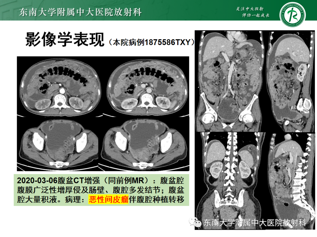影像PPT - 【PPT】腹膜弥漫性病变-48 影像PPT - 【PPT】腹膜弥漫性病变-48