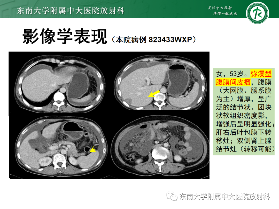 影像PPT - 【PPT】腹膜弥漫性病变-45 影像PPT - 【PPT】腹膜弥漫性病变-45