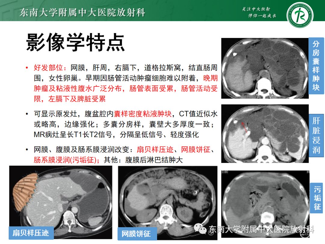 影像PPT - 【PPT】腹膜弥漫性病变-50 影像PPT - 【PPT】腹膜弥漫性病变-50