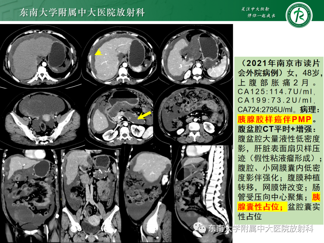 影像PPT - 【PPT】腹膜弥漫性病变-52 影像PPT - 【PPT】腹膜弥漫性病变-52