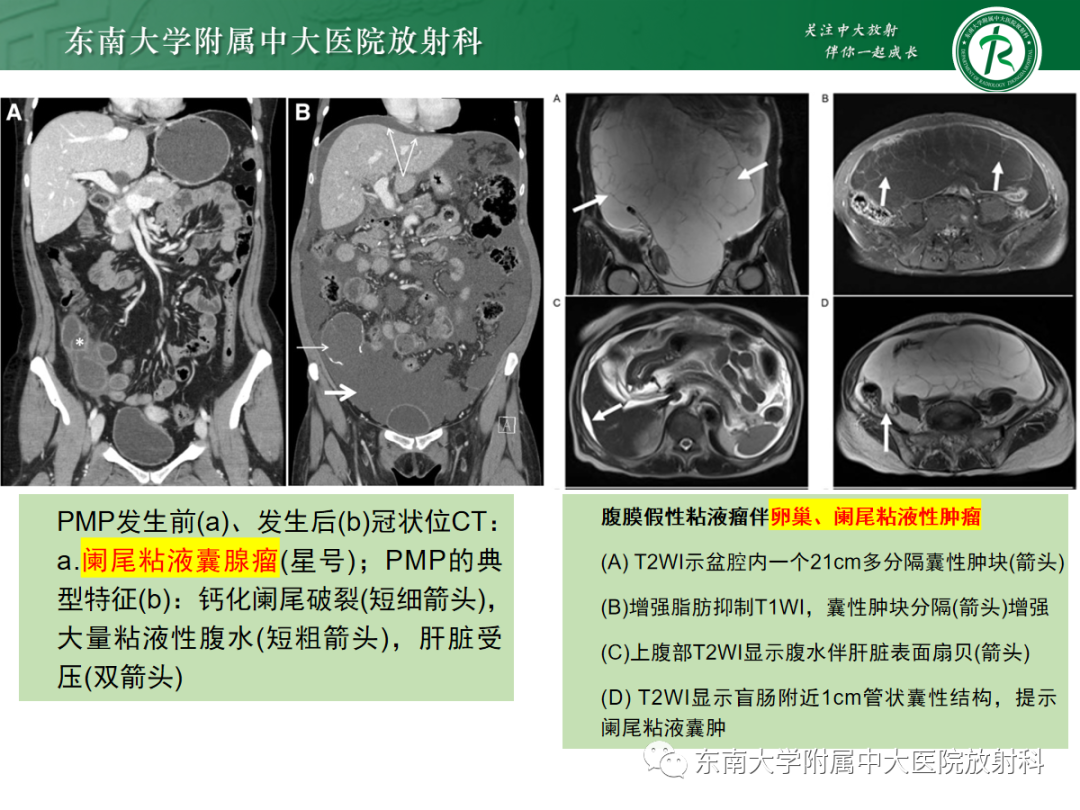影像PPT - 【PPT】腹膜弥漫性病变-51 影像PPT - 【PPT】腹膜弥漫性病变-51