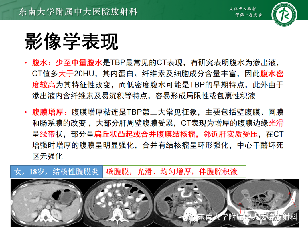 影像PPT - 【PPT】腹膜弥漫性病变-55 影像PPT - 【PPT】腹膜弥漫性病变-55