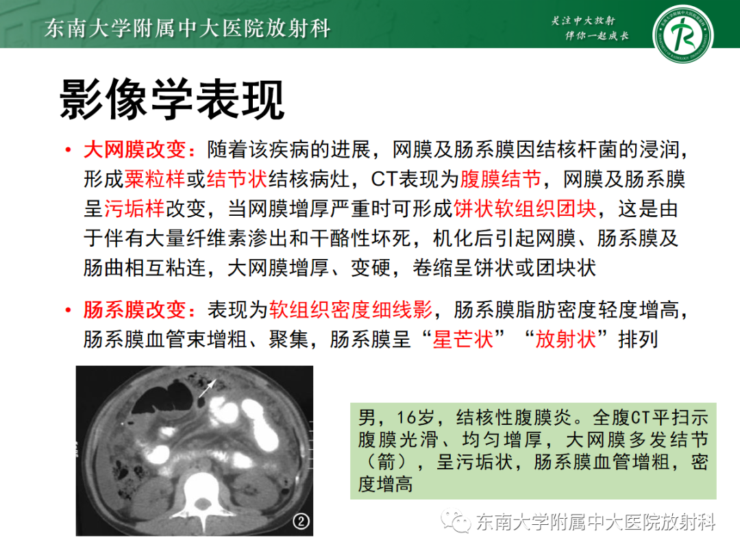 影像PPT - 【PPT】腹膜弥漫性病变-56 影像PPT - 【PPT】腹膜弥漫性病变-56
