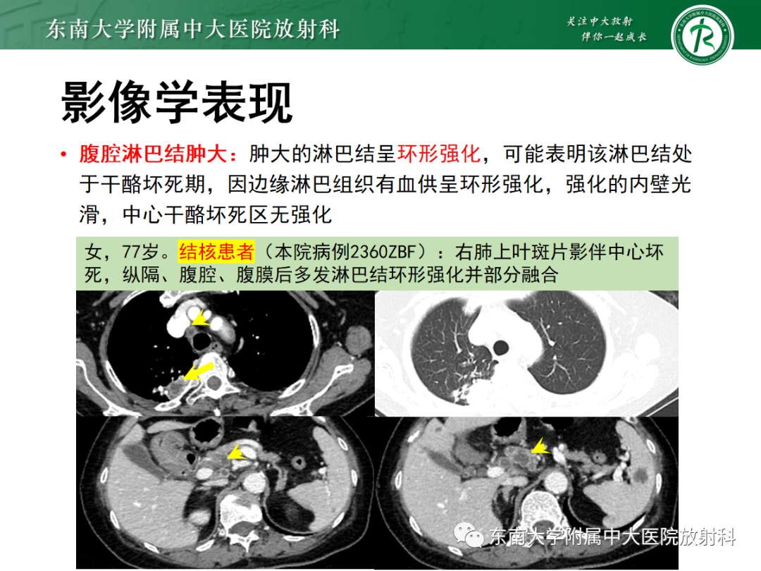 影像PPT - 【PPT】腹膜弥漫性病变-57 影像PPT - 【PPT】腹膜弥漫性病变-57