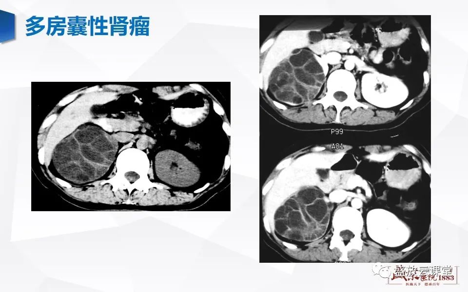 影像PPT - 【PPT】肾脏肿瘤影像诊断思辨-5