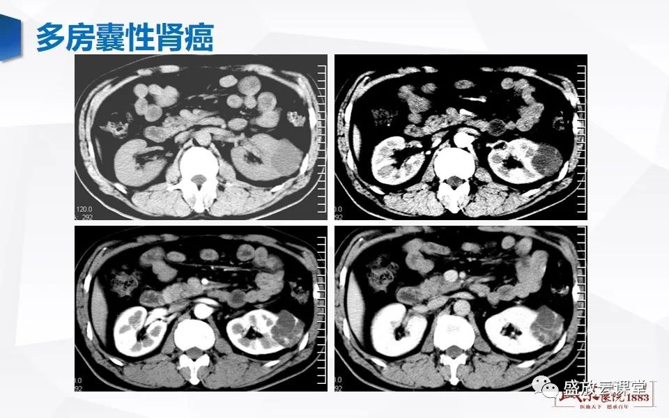 影像PPT - 【PPT】肾脏肿瘤影像诊断思辨-6