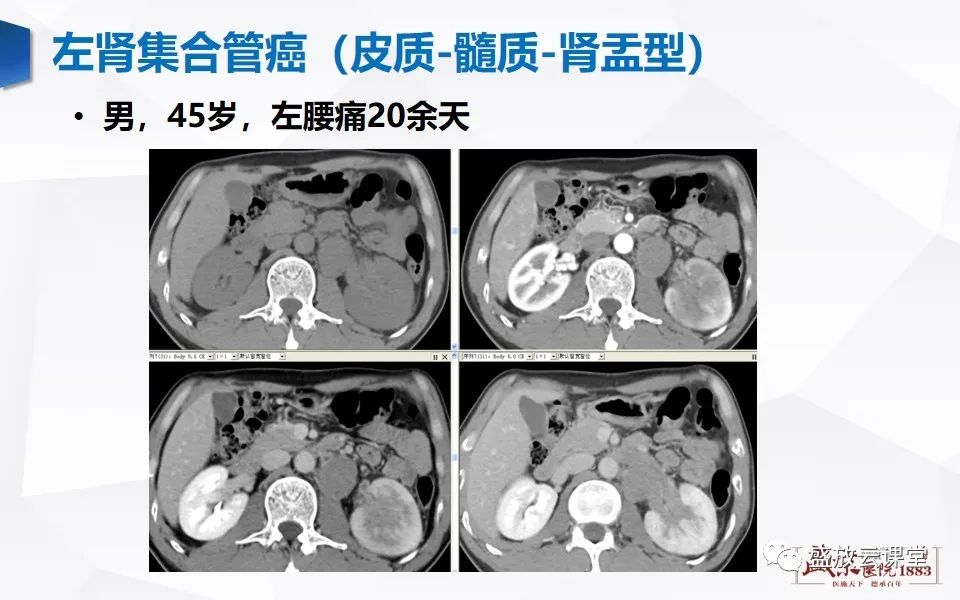 影像PPT - 【PPT】肾脏肿瘤影像诊断思辨-10