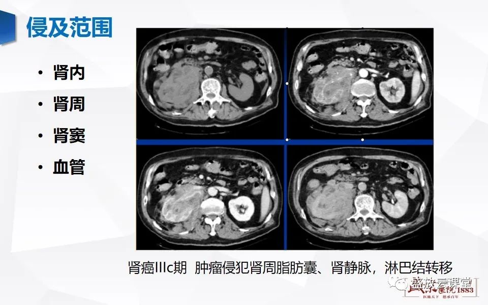 影像PPT - 【PPT】肾脏肿瘤影像诊断思辨-13