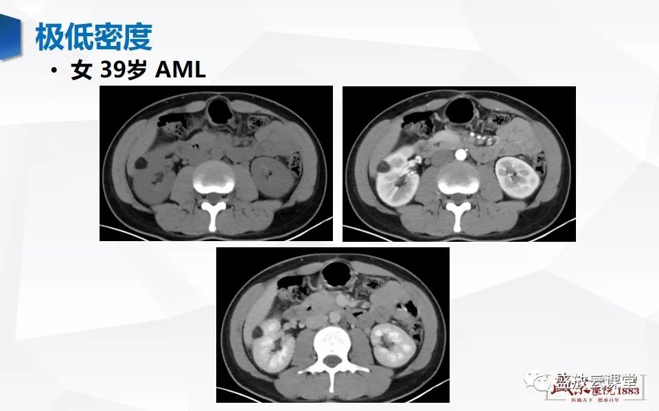 影像PPT - 【PPT】肾脏肿瘤影像诊断思辨-15