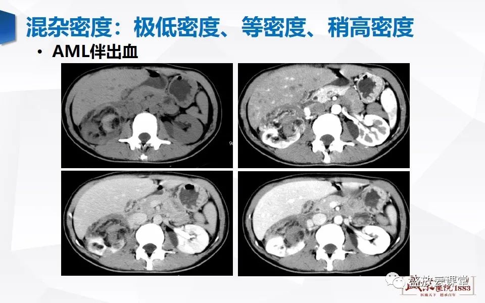 影像PPT - 【PPT】肾脏肿瘤影像诊断思辨-16
