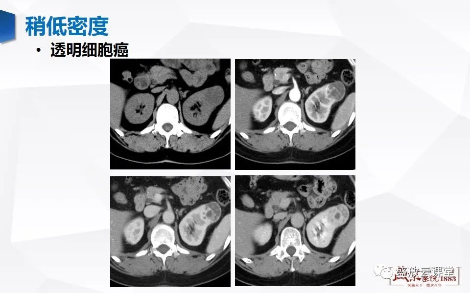 影像PPT - 【PPT】肾脏肿瘤影像诊断思辨-17