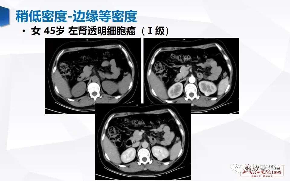 影像PPT - 【PPT】肾脏肿瘤影像诊断思辨-18