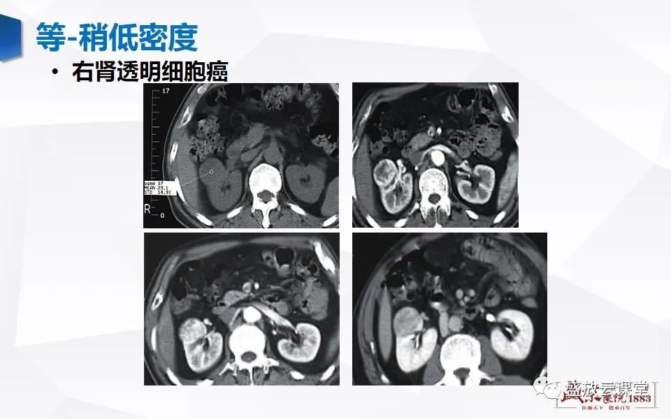 影像PPT - 【PPT】肾脏肿瘤影像诊断思辨-19