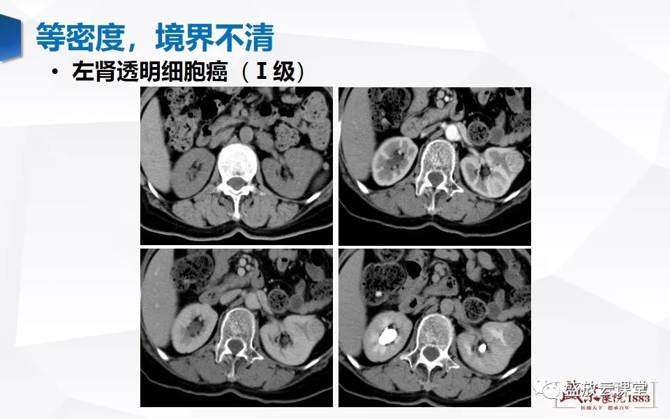 影像PPT - 【PPT】肾脏肿瘤影像诊断思辨-20