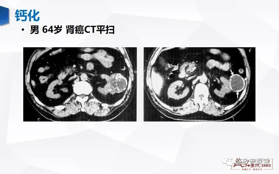 影像PPT - 【PPT】肾脏肿瘤影像诊断思辨-24
