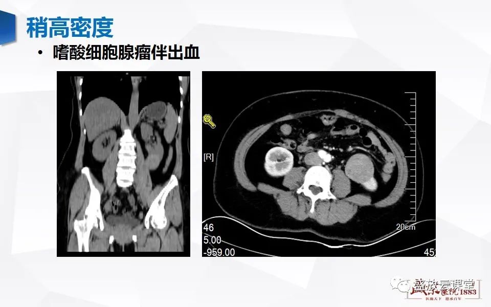 影像PPT - 【PPT】肾脏肿瘤影像诊断思辨-22