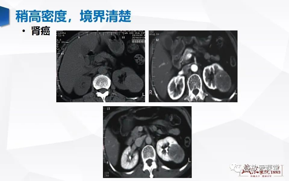 影像PPT - 【PPT】肾脏肿瘤影像诊断思辨-21