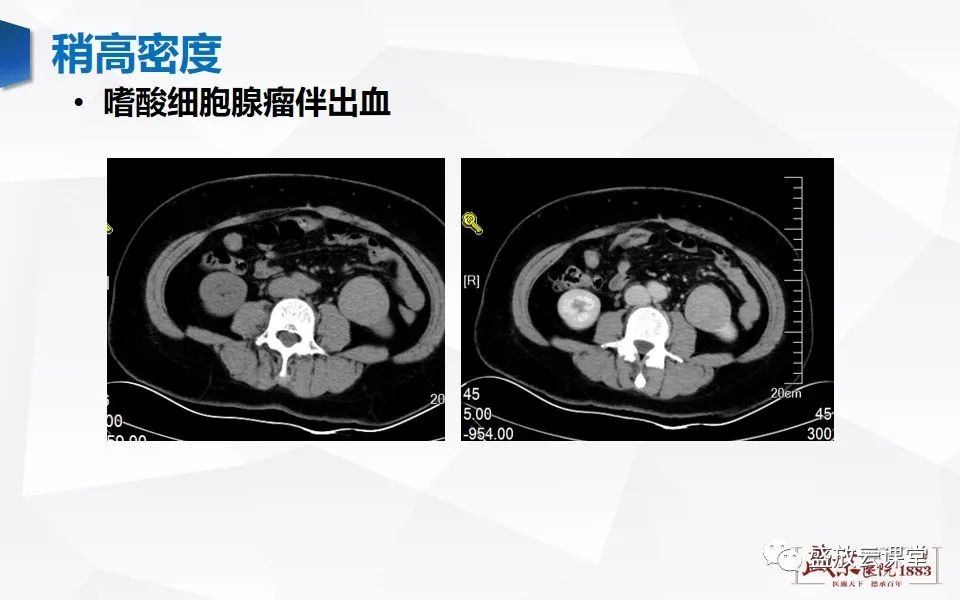 影像PPT - 【PPT】肾脏肿瘤影像诊断思辨-23