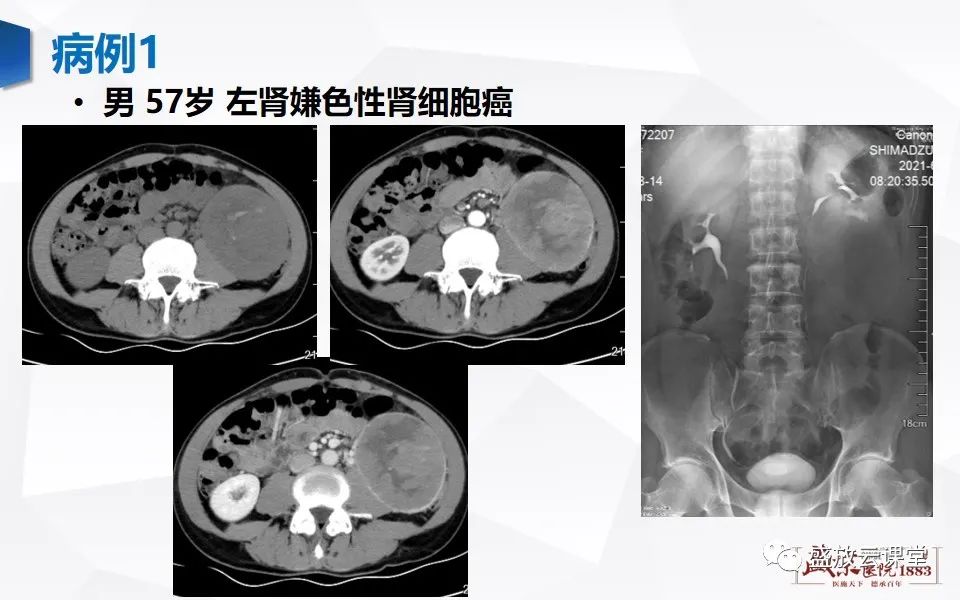 影像PPT - 【PPT】肾脏肿瘤影像诊断思辨-28