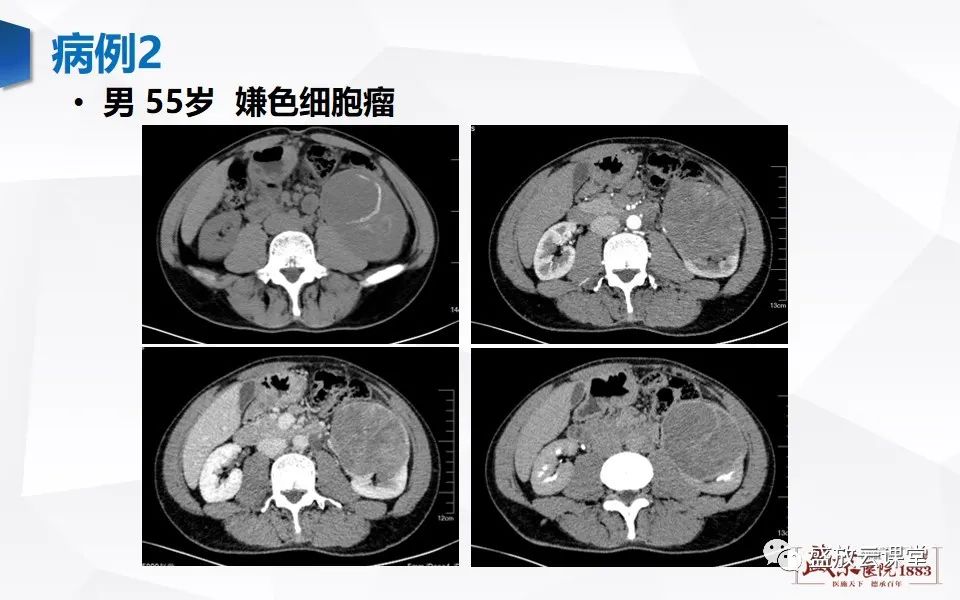 影像PPT - 【PPT】肾脏肿瘤影像诊断思辨-29
