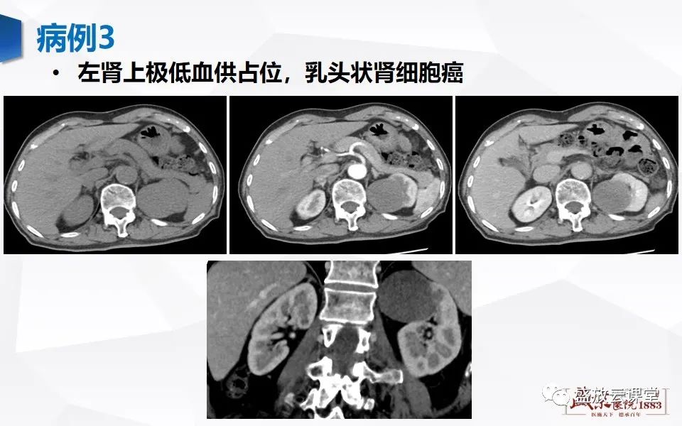 影像PPT - 【PPT】肾脏肿瘤影像诊断思辨-30