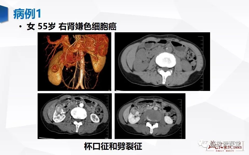 影像PPT - 【PPT】肾脏肿瘤影像诊断思辨-33