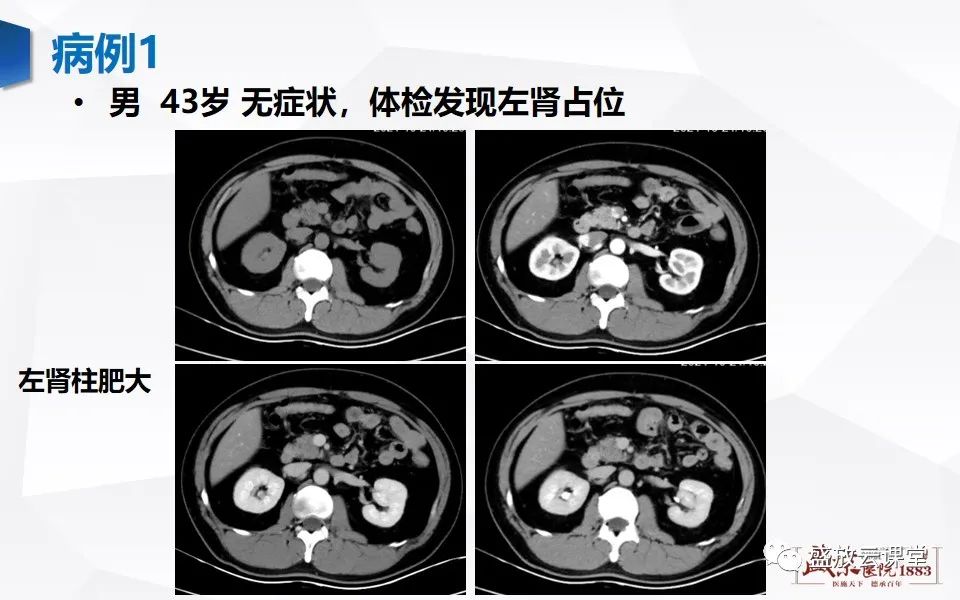 影像PPT - 【PPT】肾脏肿瘤影像诊断思辨-40