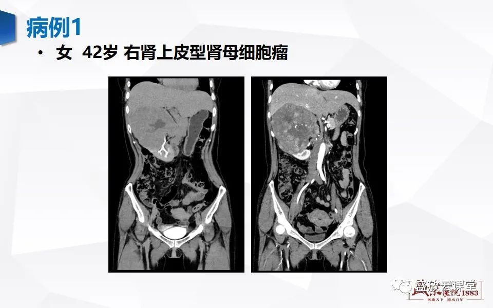 影像PPT - 【PPT】肾脏肿瘤影像诊断思辨-46