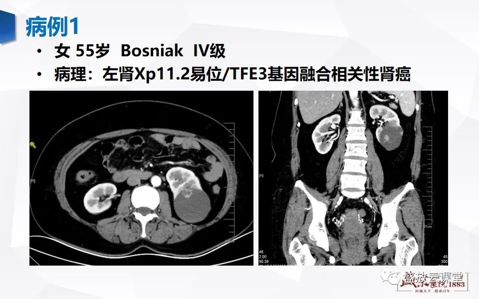 影像PPT - 【PPT】肾脏肿瘤影像诊断思辨-54