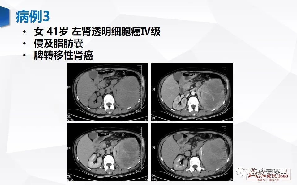 影像PPT - 【PPT】肾脏肿瘤影像诊断思辨-60