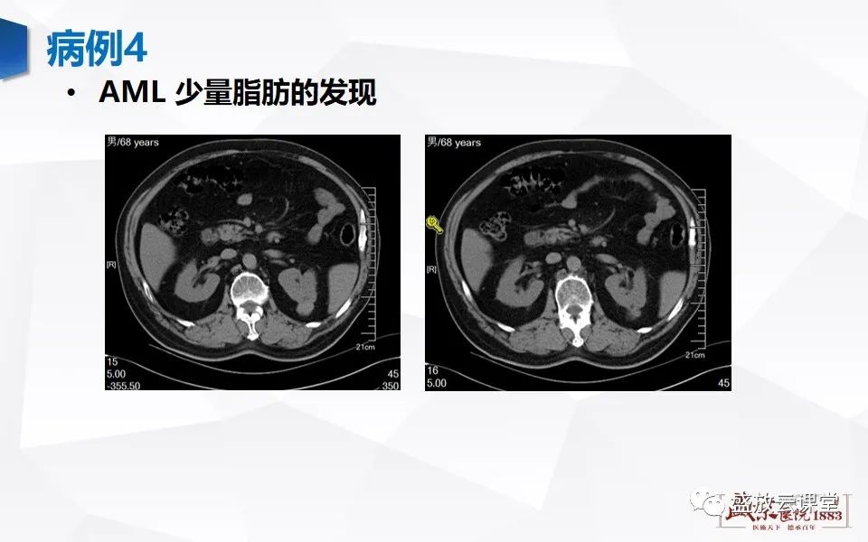 影像PPT - 【PPT】肾脏肿瘤影像诊断思辨-62