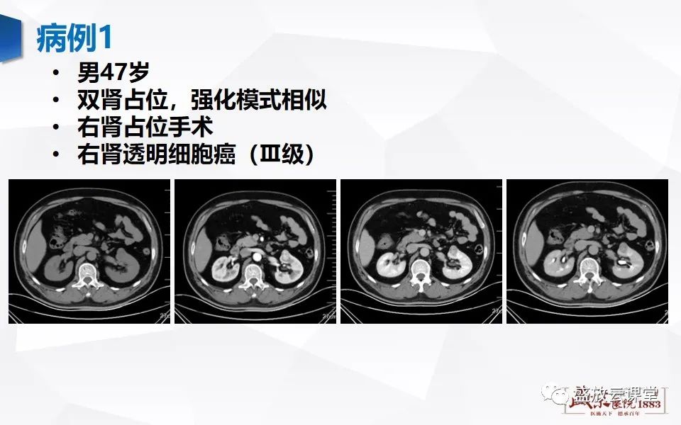 影像PPT - 【PPT】肾脏肿瘤影像诊断思辨-57