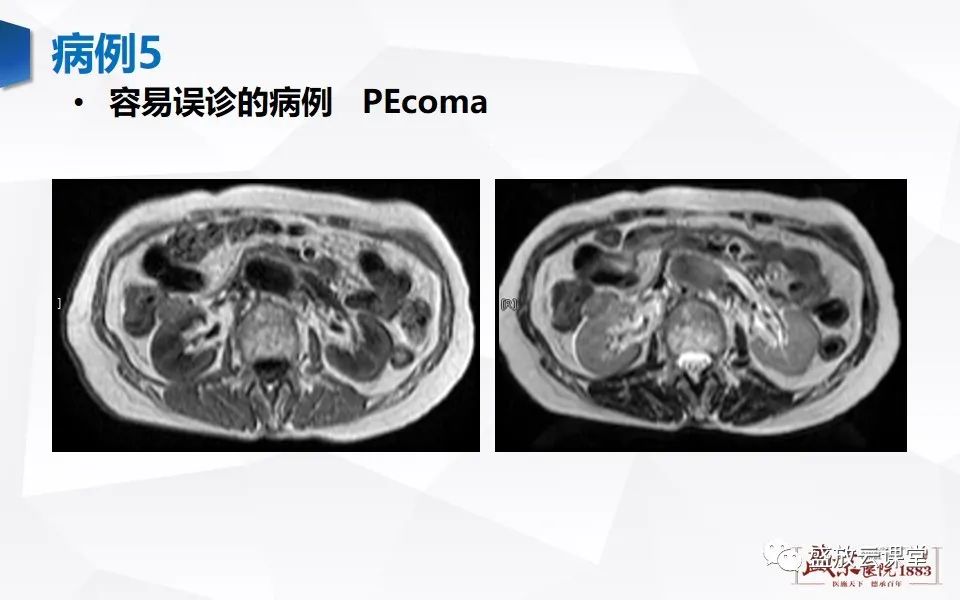 影像PPT - 【PPT】肾脏肿瘤影像诊断思辨-64