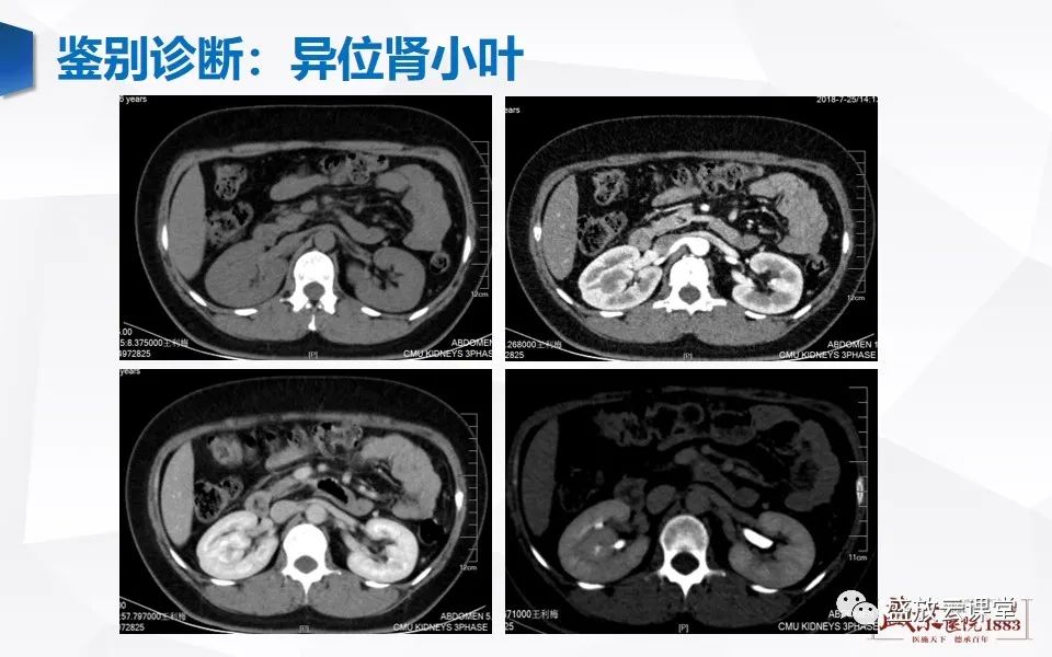 影像PPT - 【PPT】肾脏肿瘤影像诊断思辨-68