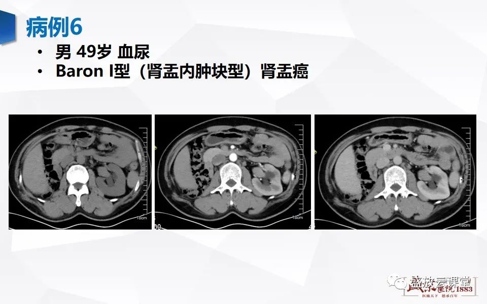 影像PPT - 【PPT】肾脏肿瘤影像诊断思辨-66