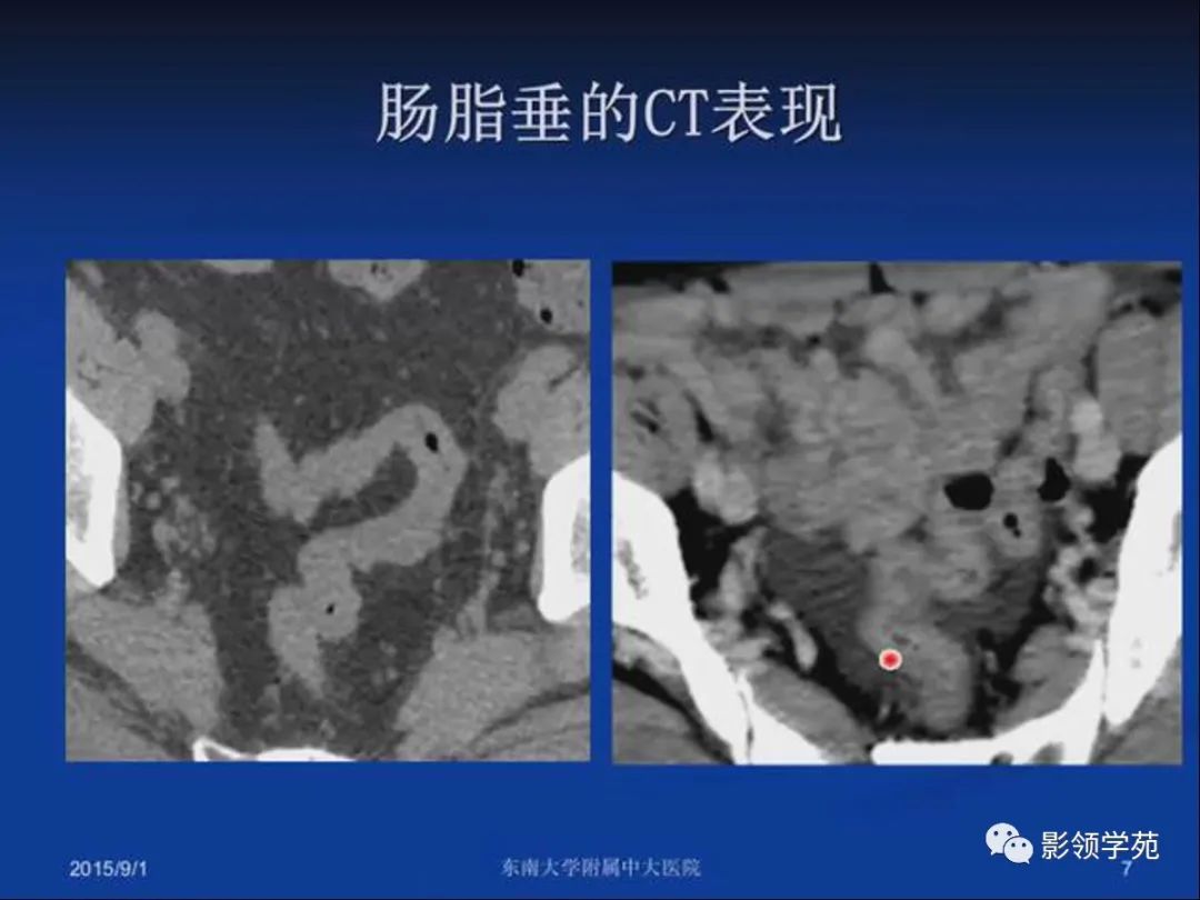 影像PPT - 【PPT】急性原发性肠脂垂炎影像诊断-7