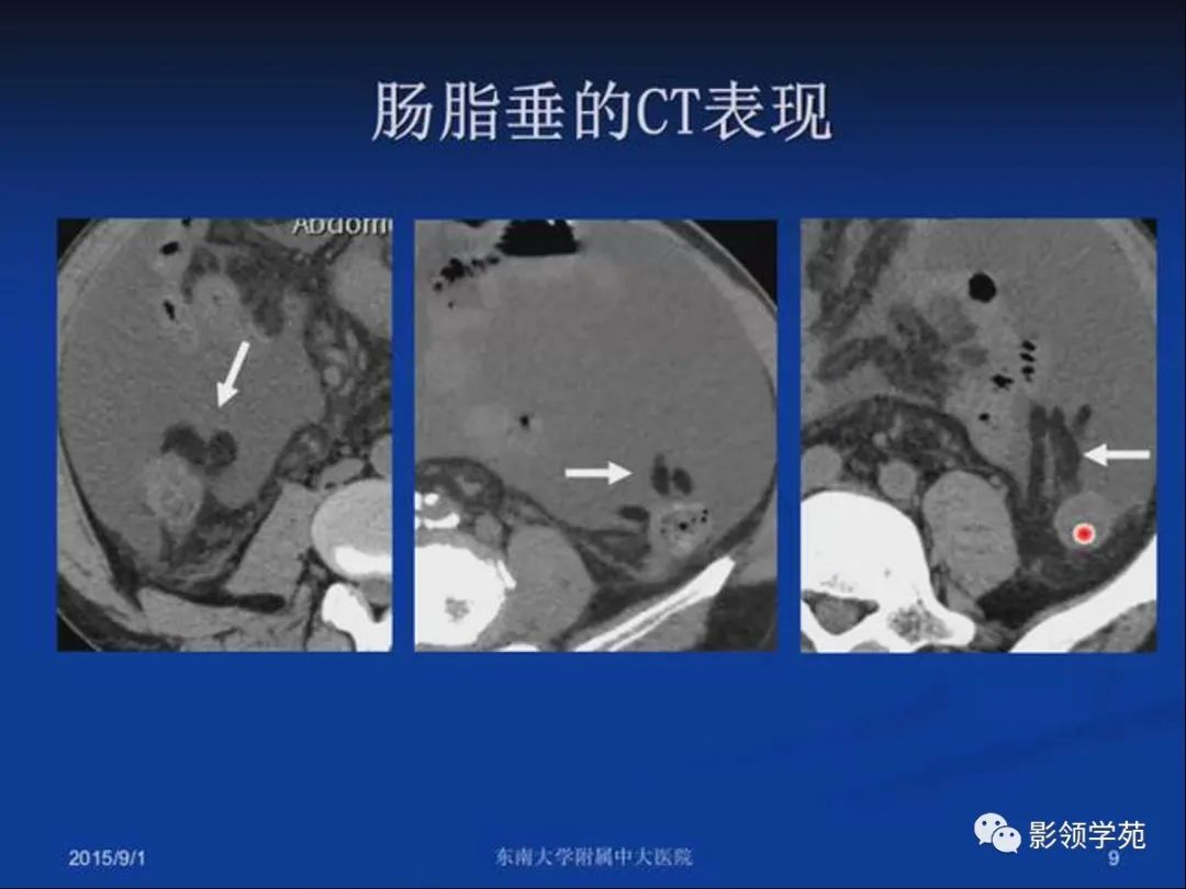 影像PPT - 【PPT】急性原发性肠脂垂炎影像诊断-9
